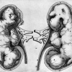 Pope Innocent XI's kidneys containing